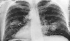 In some cases, immune cells in the lungs can contribute to worsening a virus attack.(Yahoo) In some cases, immune cells in the lungs can contribute to worsening a virus attack.(Yahoo)