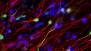 Lithium is considered the gold standard for treating bipolar disorder (BD), but nearly 70 per cent of people with BD don’t respond to it. This leaves them at risk for debilitating, potentially life-threatening mood swings.(Yahoo) Lithium is considered the gold standard for treating bipolar disorder (BD), but nearly 70 per cent of people with BD don’t respond to it. This leaves them at risk for debilitating, potentially life-threatening mood swings.(Yahoo)