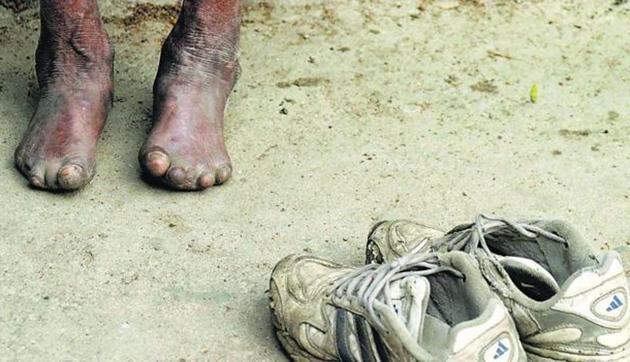 The researchers discovered that male to female ratio in the patients was 60:30, with 10% of cases reported in children. (HT file photo) The researchers discovered that male to female ratio in the patients was 60:30, with 10% of cases reported in children. (HT file photo)