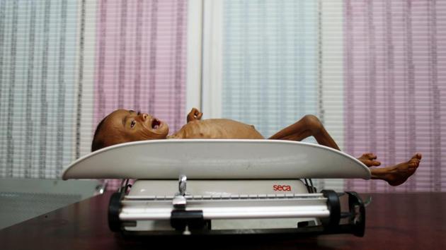 A malnourished boy lies on a scale at a malnutrition intensive care unit in the Red Sea port city of Houdeidah, Yemen November 17, 2016.(REUTERS File Photo)