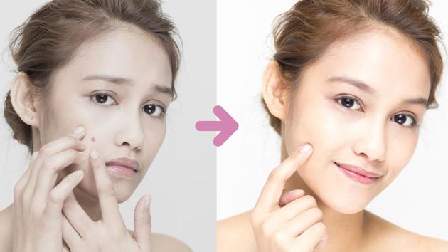 Squeezing acne leads to further inflammation, making the situation even worse. Use Benzoyl Peroxide or Salicylic acid face wash with a balanced PH. It will help control the spread. (Shutterstock) Squeezing acne leads to further inflammation, making the situation even worse. Use Benzoyl Peroxide or Salicylic acid face wash with a balanced PH. It will help control the spread. (Shutterstock)