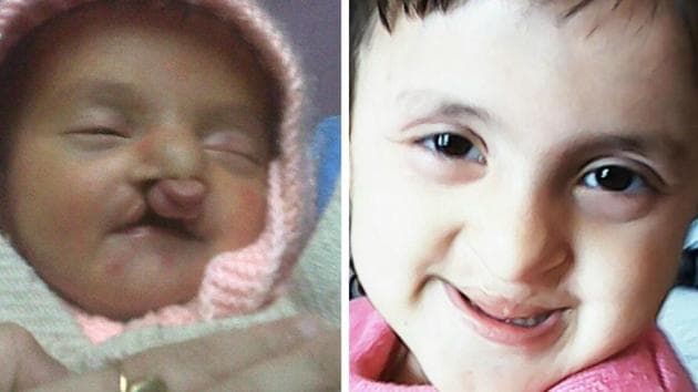 Ridhi Vashisht before and (right) after the cleft lip surgery.(HT Photo)