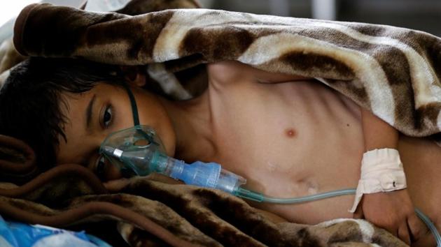 File photo of an eight-year-old malnourished boy lying on a bed in the emergency ward of a hospital in Sanaa, Yemen, in September 2016. (Reuters) File photo of an eight-year-old malnourished boy lying on a bed in the emergency ward of a hospital in Sanaa, Yemen, in September 2016. (Reuters)