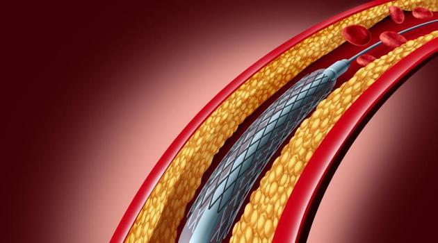 On Monday, NPPA put a cap on the prices of bare metal stents - the basic category - at Rs 7,260 and that of more advanced drug-eluting and bioresorbable stents at Rs 29,600 (HT) On Monday, NPPA put a cap on the prices of bare metal stents - the basic category - at Rs 7,260 and that of more advanced drug-eluting and bioresorbable stents at Rs 29,600 (HT)