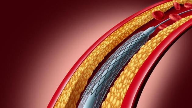 A stent is a tiny metal tube inserted into the narrowed coronary arteries (HT) A stent is a tiny metal tube inserted into the narrowed coronary arteries (HT)