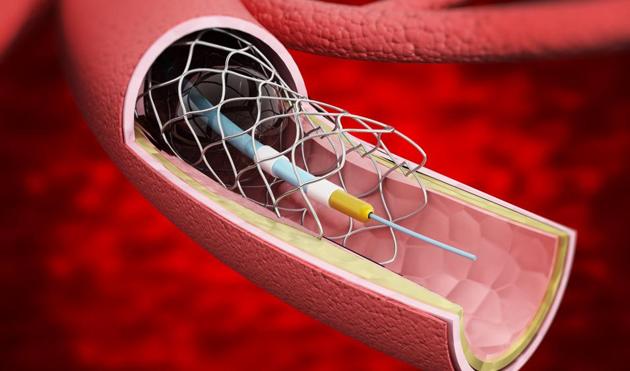 Cap on stent prices will make angioplasty procedure affordable, says ...