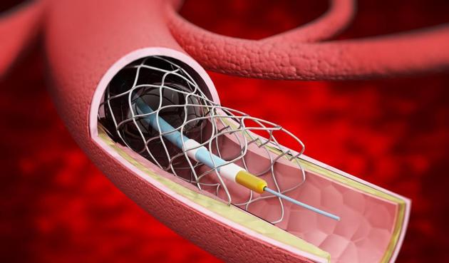 Detailed illustration showing vascular stent inside the vein.(Getty Images/iStockphoto)