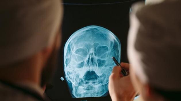 Very little is known about how people with brain trauma -- like football players and soldiers -- develop neurological disorders later in life. (Shutterstock) Very little is known about how people with brain trauma -- like football players and soldiers -- develop neurological disorders later in life. (Shutterstock)