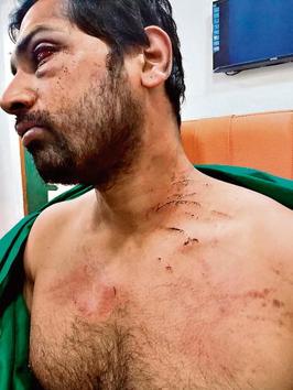 Dr Rohan Mhamunkar, a senior doctor at the Dhule civil Hospital, was assaulted by 15 to 20 relatives of a patient after he requested the family to shift the patient to another hospital owing to unavailability of a neurologist.(HT photo)