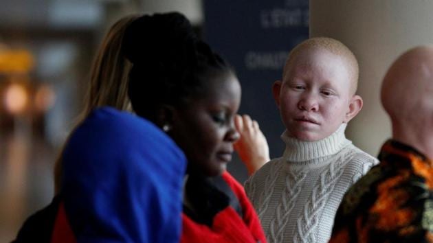 Pendo Noni, a Tanzanian with Albinism. The New York-based GMRF hosts children from around the world who have been injured in conflict or disaster. Many need prosthetics like the children from Tanzania, where people with albinism live in danger. (Brendan McDermid/REUTERS) Pendo Noni, a Tanzanian with Albinism. The New York-based GMRF hosts children from around the world who have been injured in conflict or disaster. Many need prosthetics like the children from Tanzania, where people with albinism live in danger. (Brendan McDermid/REUTERS)