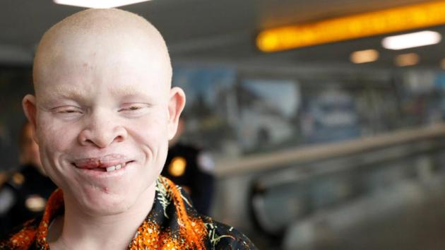 Emmanuel Rutema, a Tanzanian with Albinism visiting the U.S. for medical care, smiles after arriving at JFK International Airport in New York City. United Nations officials estimate at least 75 albinos were killed in the east African nation between 2000 and 2015. (Brendan McDermid/REUTERS) Emmanuel Rutema, a Tanzanian with Albinism visiting the U.S. for medical care, smiles after arriving at JFK International Airport in New York City. United Nations officials estimate at least 75 albinos were killed in the east African nation between 2000 and 2015. (Brendan McDermid/REUTERS)