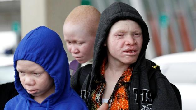 Mwigulu Magesa, Pendo Noni, and Emmanuel Rutema, (L-R) Tanzanian's with Albinism visiting the U.S. for medical care, arrive at JFK International Airport in New York City, U.S. According to the Office of the U.N. High Commissioner for Human Rights, the body parts are traded in a lucrative market for use in witchcraft. Reported prices range from $2,000 for a limb to $75,000 for a corpse. (Brendan McDermid/REUTERS) Mwigulu Magesa, Pendo Noni, and Emmanuel Rutema, (L-R) Tanzanian's with Albinism visiting the U.S. for medical care, arrive at JFK International Airport in New York City, U.S. According to the Office of the U.N. High Commissioner for Human Rights, the body parts are traded in a lucrative market for use in witchcraft. Reported prices range from $2,000 for a limb to $75,000 for a corpse. (Brendan McDermid/REUTERS)