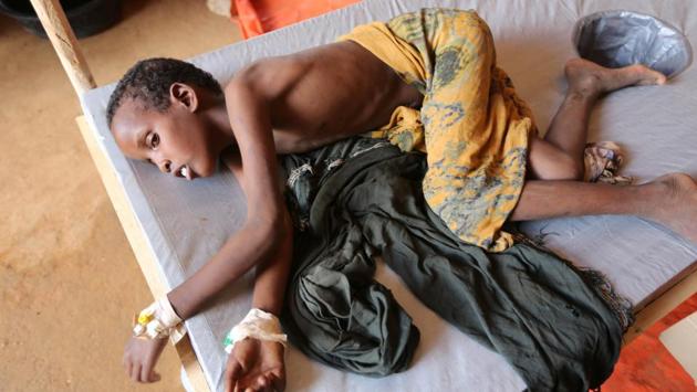 An internally displaced Somali child who fled from drought stricken regions receives treatment at a hospital’s diarrhoea ward in Baidoa. The new patients, mostly children, show signs of chronic malnourishment when they arrive at therapeutic clinics run by UNICEF, said aid workers. (Feisal Omar/REUTERS)