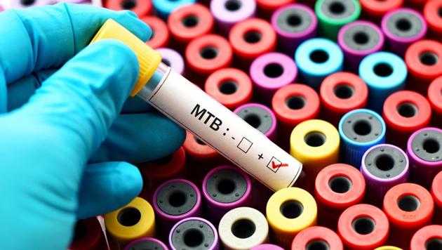 TB bacteria can lurk dormant in a person’s lung tissue, often for decades, before spontaneously producing full-blown TB disease.(Images: Shutterstock) TB bacteria can lurk dormant in a person’s lung tissue, often for decades, before spontaneously producing full-blown TB disease.(Images: Shutterstock)