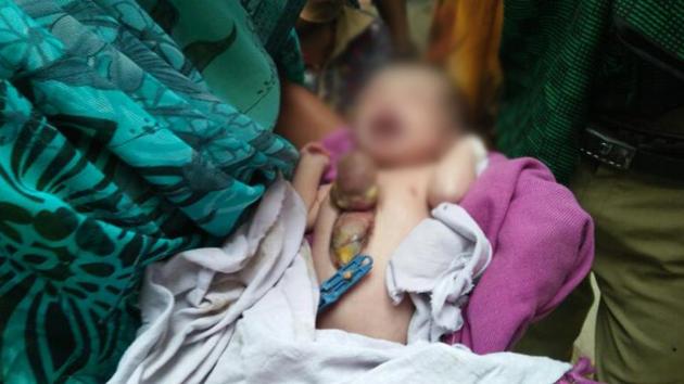 The newborn girl with a rare congenital medical condition called Ectopia Cordis is battling for her life in Bundelkhand.(HT Photo)
