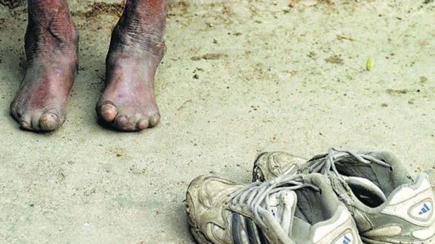 Leprosy, also known as Hansen’s disease, is a chronic infectious, but curable bacterial disease, that mainly affects the skin and the eyes. Leprosy is known to occur at all ages ranging from early infancy to very old age.(HT File) Leprosy, also known as Hansen’s disease, is a chronic infectious, but curable bacterial disease, that mainly affects the skin and the eyes. Leprosy is known to occur at all ages ranging from early infancy to very old age.(HT File)