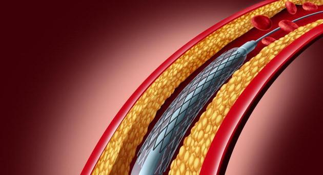 In February this year, Indian government capped the prices of coronary stents. (Representative image) In February this year, Indian government capped the prices of coronary stents. (Representative image)