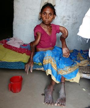 Skeletal fluorosis patient Rampatia Devi at Pratappur village(HT File Photo) Skeletal fluorosis patient Rampatia Devi at Pratappur village(HT File Photo)
