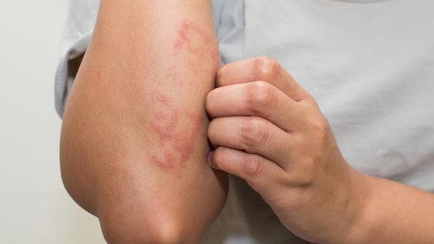 Atopic eczema is a common skin condition and often found in children in the first year of their life and persists into adulthood with severe itching that has profound effects on well-being and may lead to sleep disturbance.(Shutterstock)