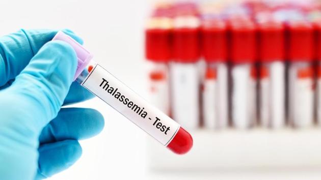 People with thalassemia produce lesser amounts of healthy haemoglobin throughout their life, and their bone marrow could even stop producing healthy red blood cells at a certain point in time.(Shutterstock) People with thalassemia produce lesser amounts of healthy haemoglobin throughout their life, and their bone marrow could even stop producing healthy red blood cells at a certain point in time.(Shutterstock)