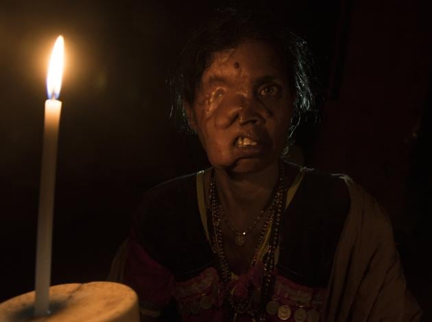 Kanta Rathore, 55, had half her face ripped off two years ago, while working on the harvest in her tur dal field. She got Rs 80,000 in compensation and had to sell her farmland to pay for treatment. Her two sons moved away; she says their wives couldn’t bear to live with her. Neighbours shun her too; she can’t even find work in the village. She now earns Rs 80 a day working as a farm labourer in a neighbouring village. “It’s not my fault that the bear attacked me,” she says, “but I am the one being punished.” (Anshuman Poyrekar / HT Photo) Kanta Rathore, 55, had half her face ripped off two years ago, while working on the harvest in her tur dal field. She got Rs 80,000 in compensation and had to sell her farmland to pay for treatment. Her two sons moved away; she says their wives couldn’t bear to live with her. Neighbours shun her too; she can’t even find work in the village. She now earns Rs 80 a day working as a farm labourer in a neighbouring village. “It’s not my fault that the bear attacked me,” she says, “but I am the one being punished.” (Anshuman Poyrekar / HT Photo)