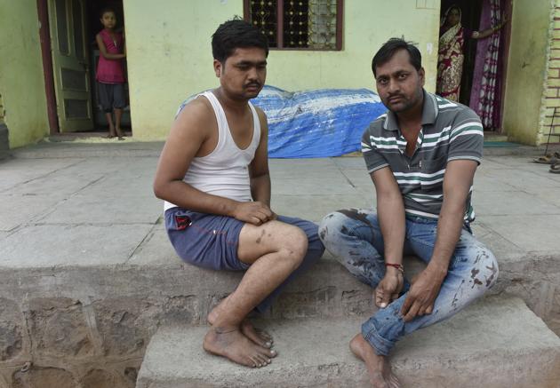 Brothers Baban, 35, and Gagan Chavan, 30, had a bear drop down on them from a tree, seemingly startled by the sound of their motorcycle. They had driven into the fringes of the forest to collect firewood. The sloth bear attacked Gagan and started biting into his arm and legs. “I picked up a rock and smashed it on its back. This just made things worse. It turned and bit my thigh,” says Baban. “I felt my jeans soaking in the blood as it rushed down my leg.” Only the sound of more bikes approaching saved the two men. “Thankfully, more villagers were coming the same way.” Gagan needed 72 stiches across his arms and legs; Baban needed 24. (Anshuman Poyrekar / HT Photo) 