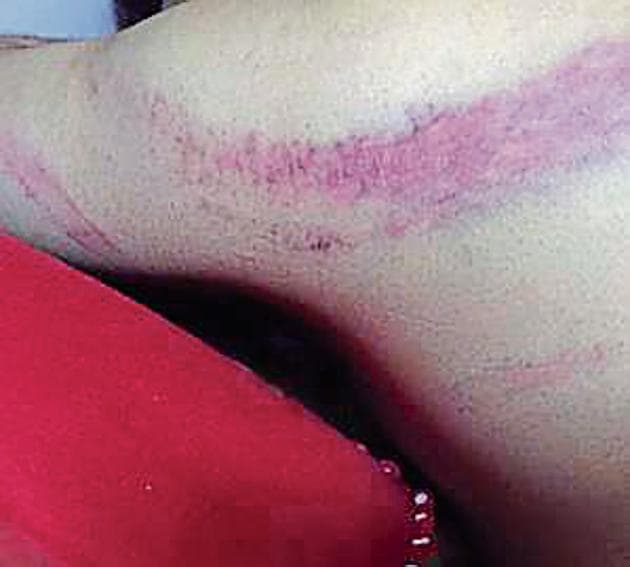 Bruises Amit Jindal received at the hands of policemen. Bruises Amit Jindal received at the hands of policemen.