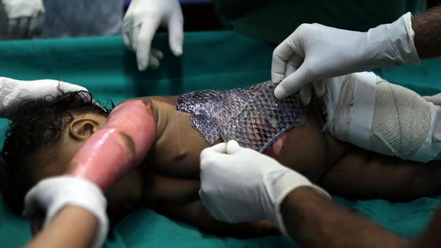 Doctors wrap a child's burnt skin with sterilised tilapia fish skin at Dr. Jose Frota Institute in the northeastern costal city of Fortaleza. Researchers in Brazil are experimenting with a new treatment for severe burns using the skin of tilapia fish, an unorthodox procedure they say can ease the pain of victims and cut medical costs. (Paulo Whitaker / Reuters) Doctors wrap a child's burnt skin with sterilised tilapia fish skin at Dr. Jose Frota Institute in the northeastern costal city of Fortaleza. Researchers in Brazil are experimenting with a new treatment for severe burns using the skin of tilapia fish, an unorthodox procedure they say can ease the pain of victims and cut medical costs. (Paulo Whitaker / Reuters)
