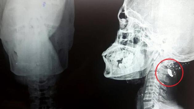 CT scan of the skull showing stuck bullet. (HT Photo) CT scan of the skull showing stuck bullet. (HT Photo)