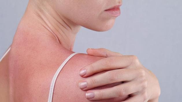 Damage from sun can be reversed.(Shutterstock) Damage from sun can be reversed.(Shutterstock)