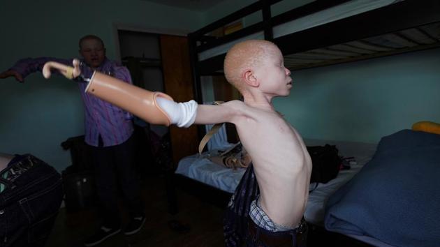 A 7 year old Tanzanian child puts on his prosthetic limbs at a temporary foster home. The children are able to attach and adjust prosthetic arms to their bodies, wash their laundry by hand and hang it to dry and even make dinner. (Carlo Allegri/REUTERS) A 7 year old Tanzanian child puts on his prosthetic limbs at a temporary foster home. The children are able to attach and adjust prosthetic arms to their bodies, wash their laundry by hand and hang it to dry and even make dinner. (Carlo Allegri/REUTERS)