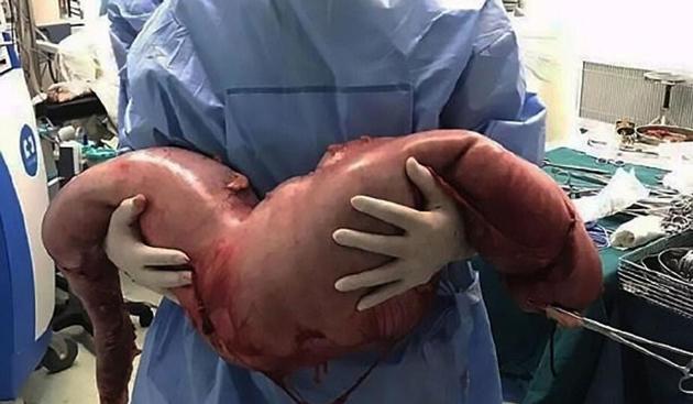 Doctors in China removed a 30-inch long section of his colon filled with 13kg of faeces during the three-hour-long surgery(© AsiaWire)