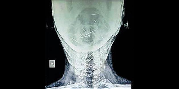 Badrilal (56), a railway employee from Barda village in Bundi district in Rajasthan, was detected with 71 pins two months ago when he underwent an X-ray. (HT File Photo) Badrilal (56), a railway employee from Barda village in Bundi district in Rajasthan, was detected with 71 pins two months ago when he underwent an X-ray. (HT File Photo)