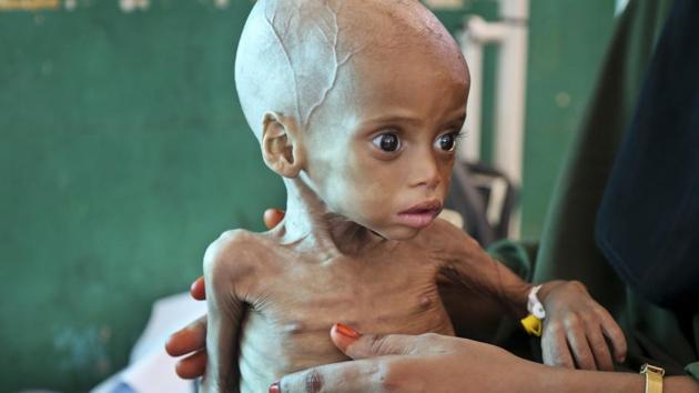 A malnourished child Sacdiyo Mohamed, 9 months old, is treated at the Banadir Hospital after her mother Halima Hassan Mohamed fled the drought in southern Somalia and travelled by car to the capital Mogadishu, in Somalia five months ago. (Mohamed Sheikh Nor / AP)