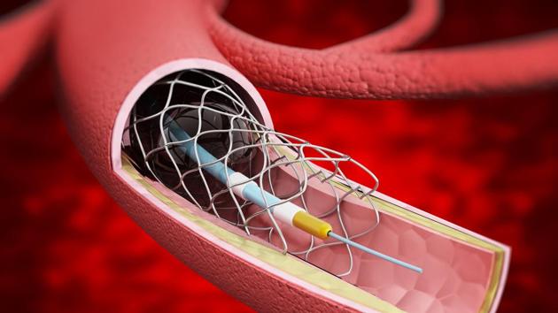 Detailed illustration showing vascular stent inside the vein. (Getty Images/iStockphoto) Detailed illustration showing vascular stent inside the vein. (Getty Images/iStockphoto)