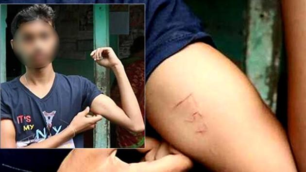 Raunak Singha, a Class 11 student at the Garbeta High School in Midnapore, said he followed the instructions of Blue Whale Challenge and wrote “F57” on his hand using a knife. (HT Photo) Raunak Singha, a Class 11 student at the Garbeta High School in Midnapore, said he followed the instructions of Blue Whale Challenge and wrote “F57” on his hand using a knife. (HT Photo)