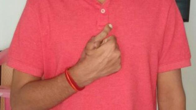 Kurne’s severed thumb was replaced with his toe. (HT) Kurne’s severed thumb was replaced with his toe. (HT)