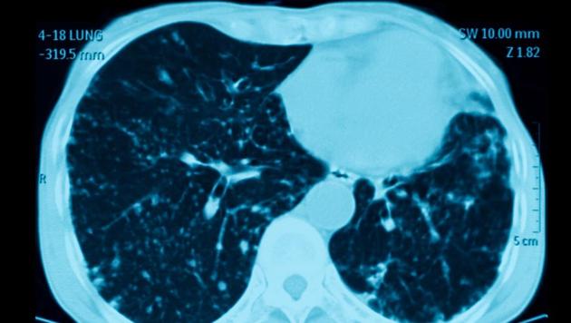 According to a study published in the journal Lancet, death from cancer was reduced by half in the group of people who received the highest dosage of the drug. (Shutterstock) According to a study published in the journal Lancet, death from cancer was reduced by half in the group of people who received the highest dosage of the drug. (Shutterstock)