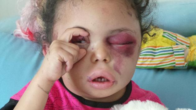 Buthaina Muhammad Mansour is the only survivor in her family of eight after an air strike hit their apartment in Sanaa, Yemen.(Twitter)