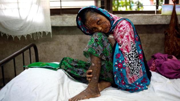Shaheda, 40, a Rohingya refugee woman who said her body was burnt when the Myanmar Army set fire to her house, receives treatment at the Sadar Hospital in Cox's Bazar, Bangladesh, on September 19, 2017. (Reuters) Shaheda, 40, a Rohingya refugee woman who said her body was burnt when the Myanmar Army set fire to her house, receives treatment at the Sadar Hospital in Cox's Bazar, Bangladesh, on September 19, 2017. (Reuters)
