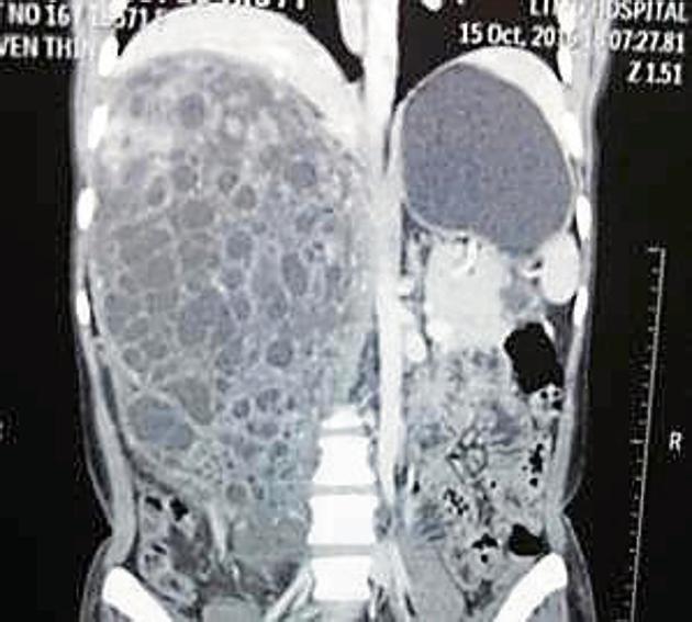 A CT scan of Manju Devi that shows the tumour.