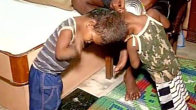 The conjoined twins were taken to AIIMS in Delhi on July 14 from Milipada village in Kandhamal district of Odisha.(ANI File) The conjoined twins were taken to AIIMS in Delhi on July 14 from Milipada village in Kandhamal district of Odisha.(ANI File)