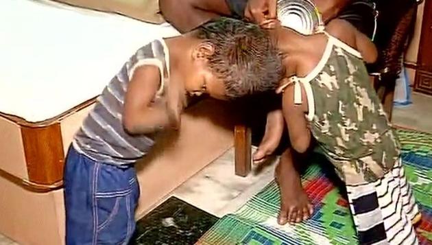 The conjoined twins were taken to AIIMS on July 14 from Milipada village in Kandhamal district of Odisha. (ANI File) The conjoined twins were taken to AIIMS on July 14 from Milipada village in Kandhamal district of Odisha. (ANI File)