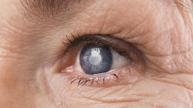 Previous studies have suggested an association between cataract surgery and decreased risk from all causes of mortality potentially through a mechanism of improved health status and functional independence. (Shutterstock) Previous studies have suggested an association between cataract surgery and decreased risk from all causes of mortality potentially through a mechanism of improved health status and functional independence. (Shutterstock)