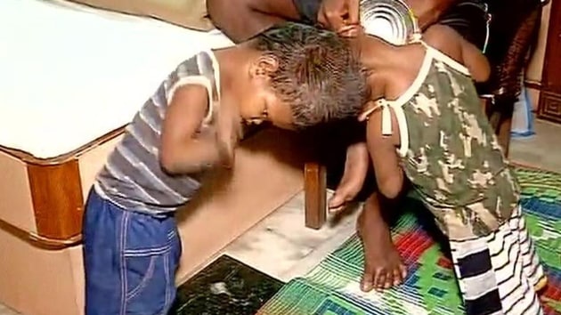 File photo of the conjoined twins before their surgery last week at AIIMS in New Delhi. (ANI) File photo of the conjoined twins before their surgery last week at AIIMS in New Delhi. (ANI)