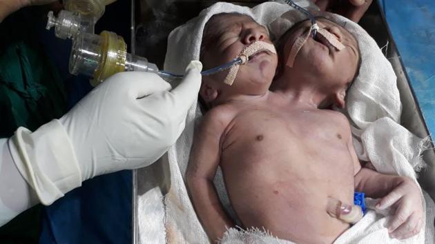 Doctors said the twins were born on October 29 and died of respiratory disorder. (HT) Doctors said the twins were born on October 29 and died of respiratory disorder. (HT)