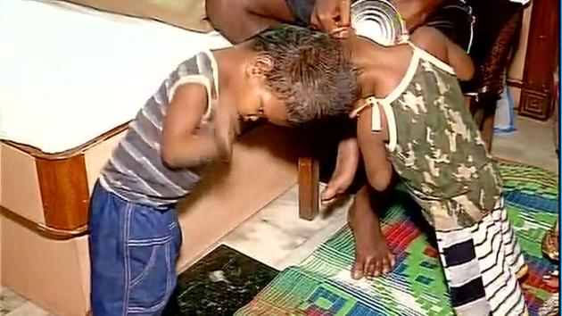 A file photo of the conjoined twins before their surgery at AIIMS in New Delhi. ((ANI)) A file photo of the conjoined twins before their surgery at AIIMS in New Delhi. ((ANI))