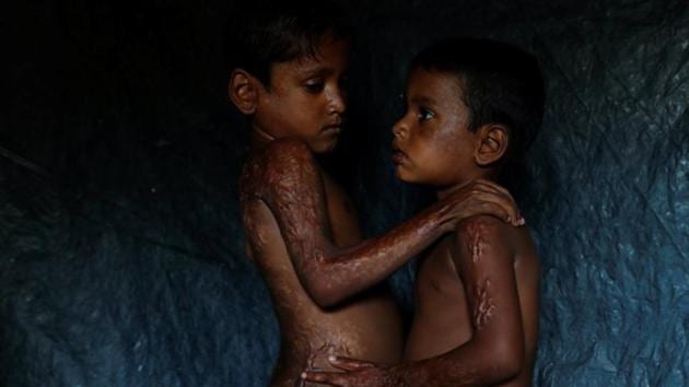 Mohamed Heron, 6, and his brother Mohamed Akter, 4 show burns on their bodies at a refugee camp in Bangladesh. Their uncle Mohamed Inus said the burns resulted from Myanmar armed forces firing rockets at their village. According to him, two of their siblings died in the attack while their father was held by the military and has not been heard of since. (Jorge Silva / REUTERS) Mohamed Heron, 6, and his brother Mohamed Akter, 4 show burns on their bodies at a refugee camp in Bangladesh. Their uncle Mohamed Inus said the burns resulted from Myanmar armed forces firing rockets at their village. According to him, two of their siblings died in the attack while their father was held by the military and has not been heard of since. (Jorge Silva / REUTERS)