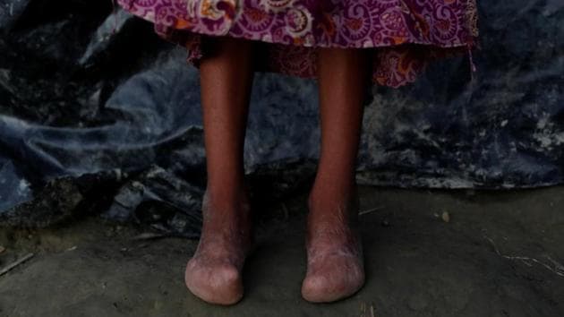 Setara Begum, 12 who was among her nine siblings in their home when it was hit by a rocket. Her mother Arafa, said, “I saved eight of my nine children from the burning house, but Setara was trapped inside. I could see her crying in the middle of the fire, but it was difficult to save her.” According to her family Setara received no treatment for her burns and has been mute from that day. (Jorge Silva / REUTERS) Setara Begum, 12 who was among her nine siblings in their home when it was hit by a rocket. Her mother Arafa, said, “I saved eight of my nine children from the burning house, but Setara was trapped inside. I could see her crying in the middle of the fire, but it was difficult to save her.” According to her family Setara received no treatment for her burns and has been mute from that day. (Jorge Silva / REUTERS)