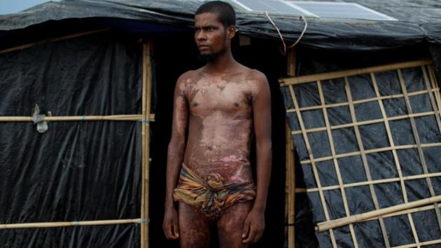 Mohamed Jabair, 21, poses for a photograph to show the burns on his body near Cox’s Bazar in Bangladesh. Since the crisis began, Chittagong Medical College Hospital has received 261 casualties suffering wounds from gunshots or explosions, according to its director, Brigadier General Jalal Uddin. (Jorge Silva / REUTERS) Mohamed Jabair, 21, poses for a photograph to show the burns on his body near Cox’s Bazar in Bangladesh. Since the crisis began, Chittagong Medical College Hospital has received 261 casualties suffering wounds from gunshots or explosions, according to its director, Brigadier General Jalal Uddin. (Jorge Silva / REUTERS)